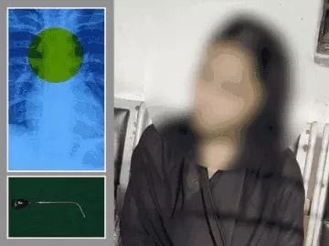 હિજાબમાં લગાવવાની પીન ગળી જતા કિશોરીનો જીવ જોખમાયો