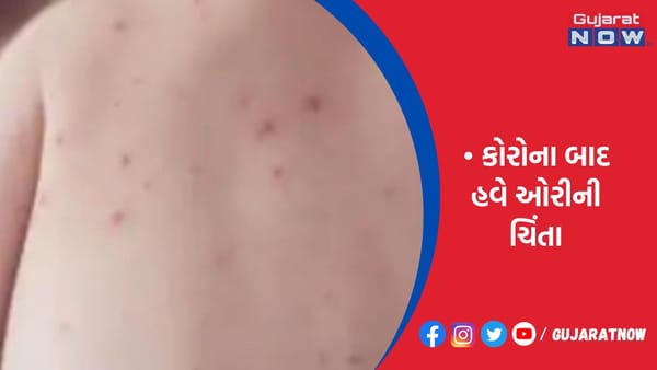 કોરોના બાદ હવે ઓરીની ચિંતા!