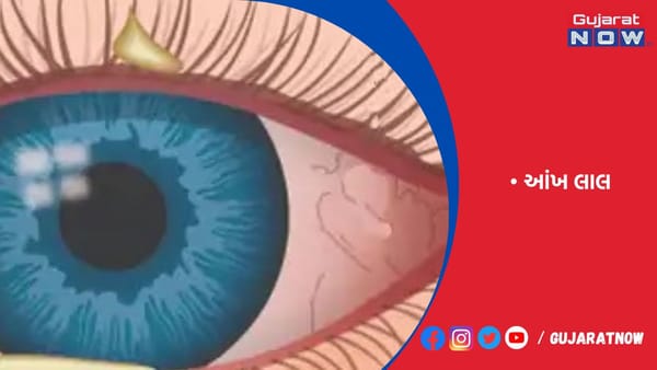 રાજકોટમાં કંજંક્ટિવાઇટિસમાં ઉછાળો, સિવિલમાં એક જ દિવસમાં 30 કેસ